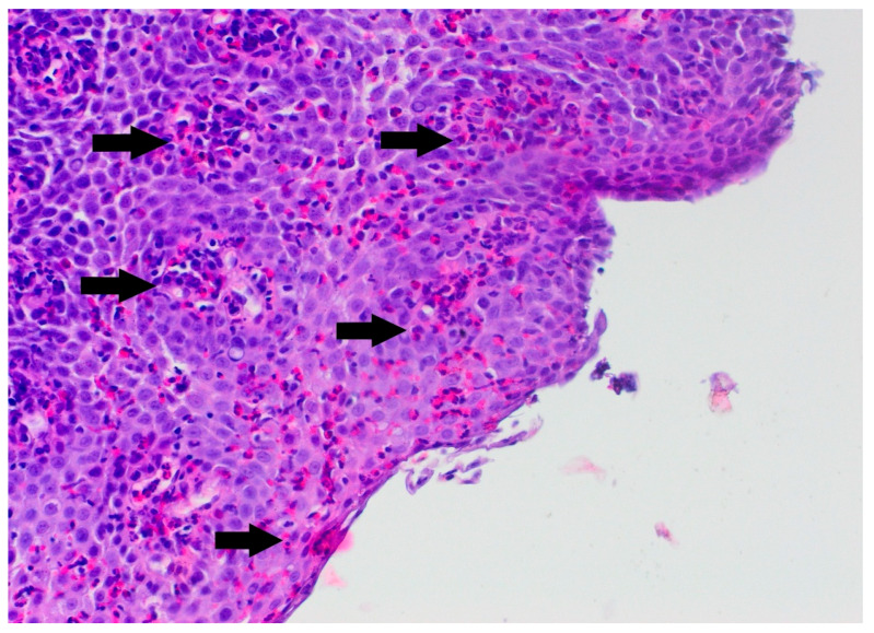 Eosinophilic Esophagitis in a 3-Year-Old Girl with Spinal Muscular Atrophy Type 1: The First Reported Case.