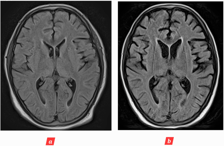 Age inconsistent brain atrophy following post cardiac arrest brain injury (PCABI): case report and review of literature.
