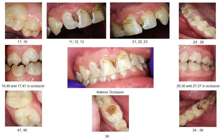 A Mixed-Methods Case Report on Oral Health Changes and Patient Perceptions and Experiences Following Treatment at the One Smile Research Program: A 2-Year Follow-Up.