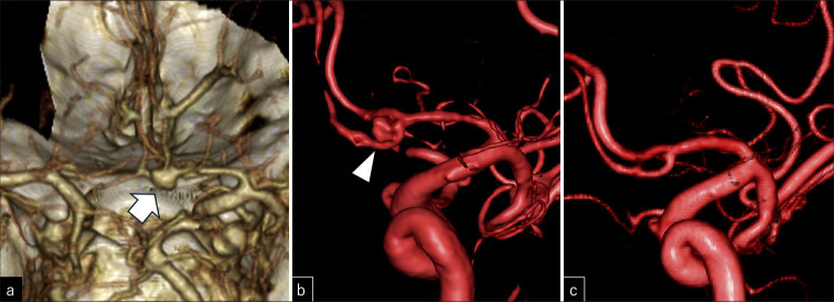Appearance of an anterior communicating artery aneurysm during vasospasm treatment after angiogram-negative subarachnoid hemorrhage: A case report.