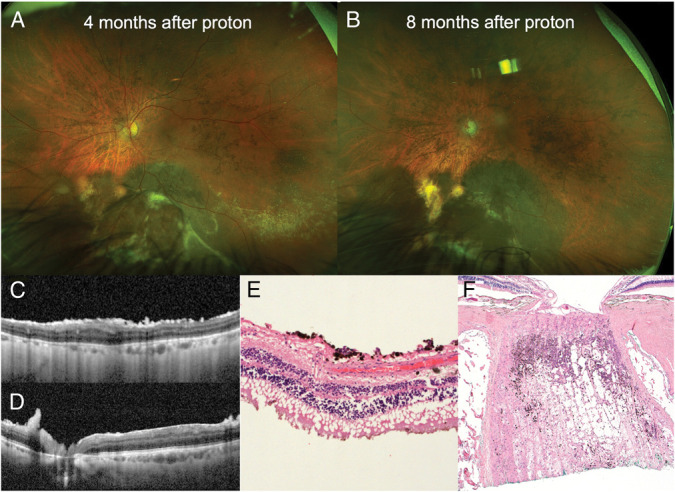 Dissemination of Uveal Melanoma After Diagnostic Biopsy With 23-Gauge Vitrector.