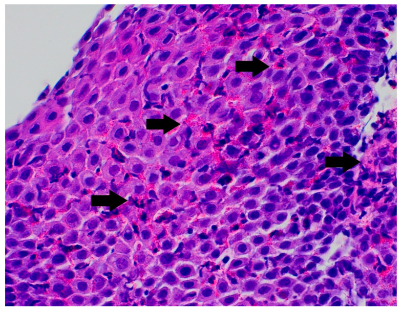 Eosinophilic Esophagitis in a 3-Year-Old Girl with Spinal Muscular Atrophy Type 1: The First Reported Case.