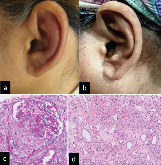 Auricular Chondritis and Renal Medullary Angiitis - An Uncommon Manifestation of Antineutrophilic Cytoplasmic Antibody Associated Vasculitis.