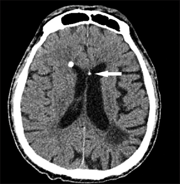 Intraventricular and subarachnoid migration of silicone oil from previous intraocular injection mimicking intracranial haemorrhage: a case report.