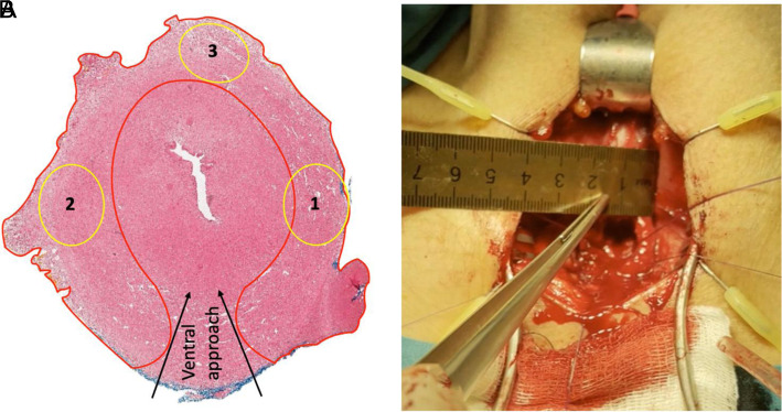 Histotopographic Reasons for Ventral Approach in Bulbous Non-Transecting Urethroplasty.