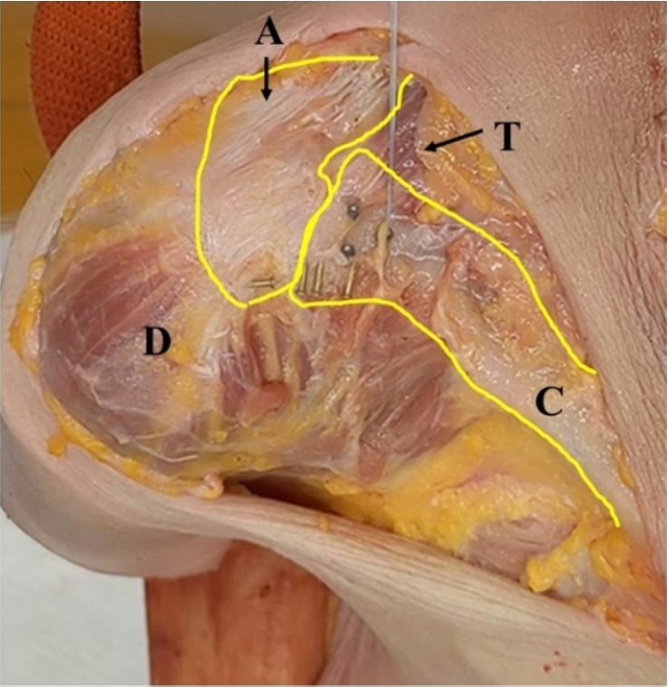 Effects of acromioclavicular and coracoclavicular ligament stability on acromioclavicular joint dislocation: insights from a cadaveric study.
