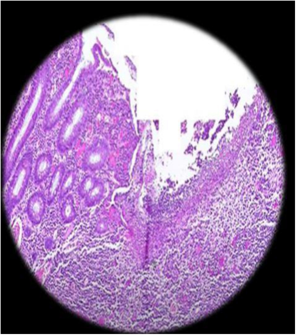 A 17-year-old female with Down syndrome and Crohn's disease: a rare case report from Syria.