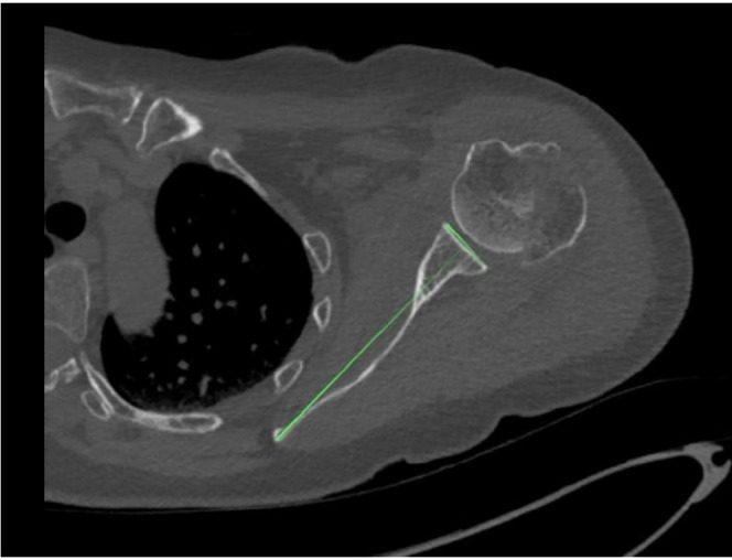 A comparative analysis of manual glenoid version measurement using two-dimensional and three-dimensional computed tomography imaging techniques.