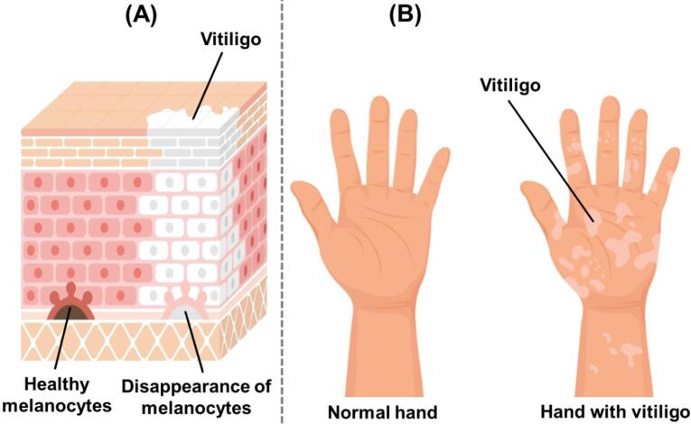 Lipid-based nanoparticles: advancing therapeutic strategies for vitiligo management.