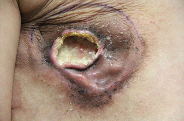 Complicated breast cellulitis status post-bilateral mastectomies caused by infection with Staphylococcus coagulans.