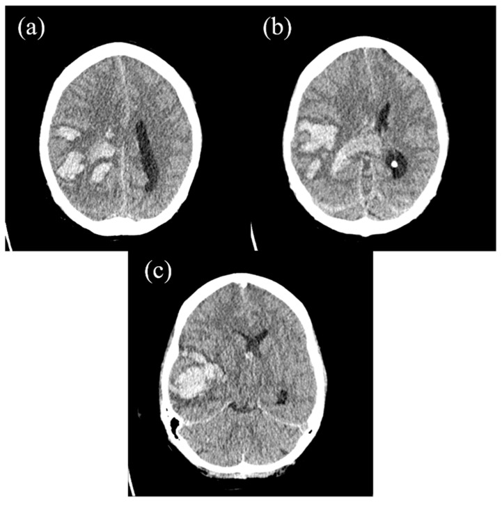 Diagnostic Challenges in Acute Leukemia: From Dental Pain to Catastrophic Intracerebral Hemorrhage.