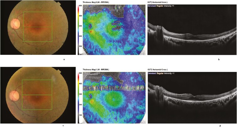Evaluating the long-term efficacy of umbilical cord-derived mesenchymal stem cell therapy in retinitis pigmentosa: findings from a 1-to-4-year follow-up.
