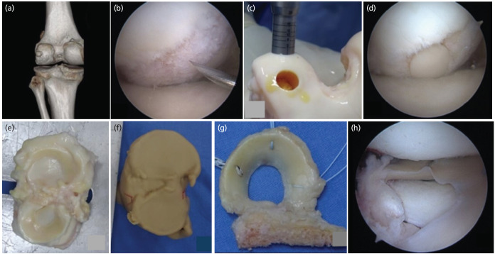 Strategic Integration of Surgical Techniques for Knee Preservation: A Case Report.