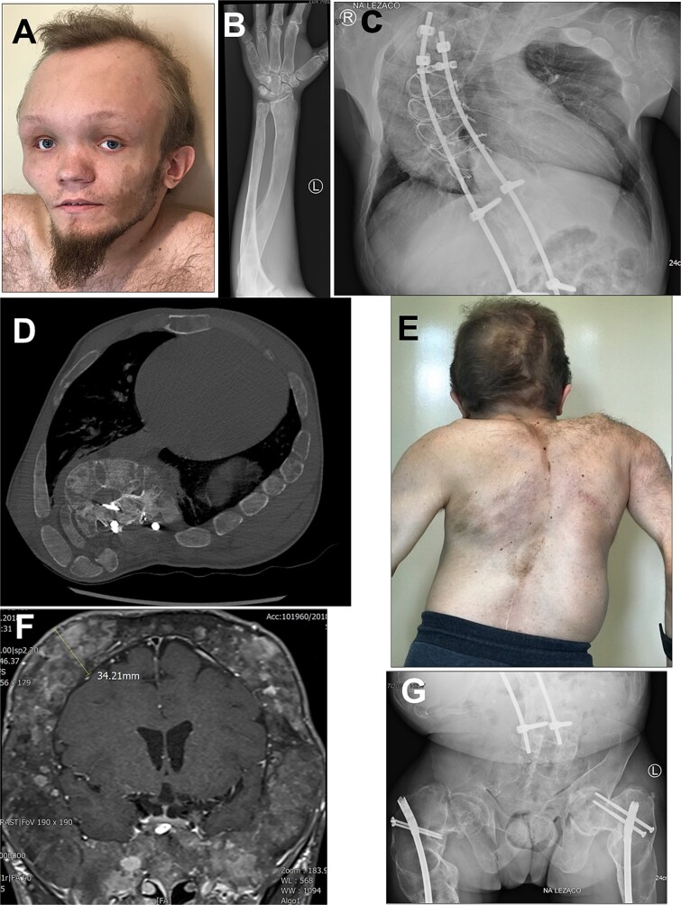 Burosumab treatment for fibroblast growth factor-23-associated hypophosphatemia in an adult patient with severe fibrous dysplasia in McCune-Albright syndrome: case report and review of the literature.
