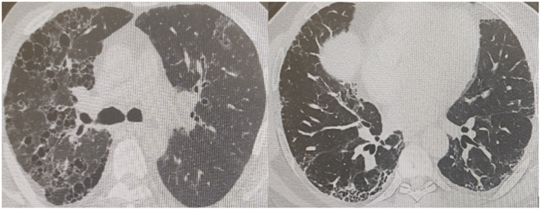 Interstitial Lung Disease Associated with Autoimmune Rheumatic Diseases: An Experience from Türkiye.