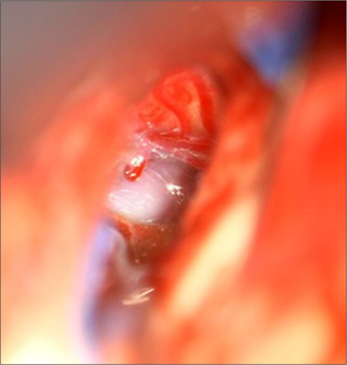 Intrinsic brainstem epidermoid cyst in childhood.