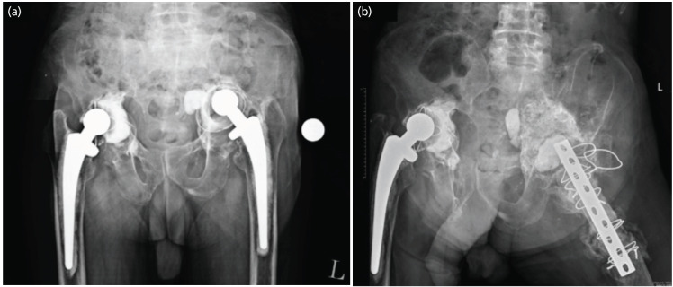 Two-stage Acetabular Impaction Bone Grafting: A Case Report.