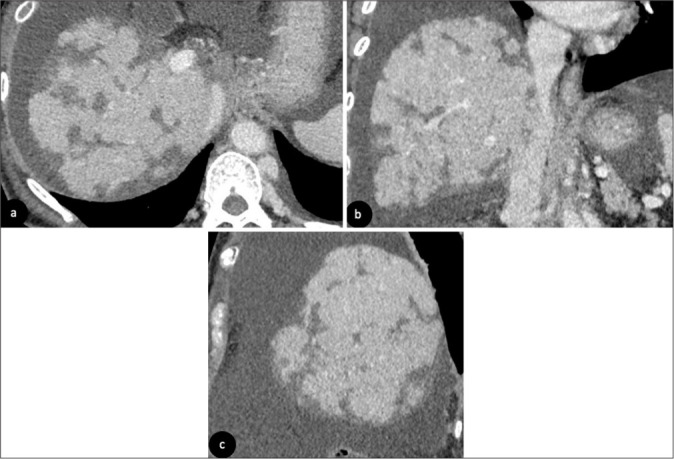 Imaging findings of post-chemotherapy non-metastatic hepatic parenchymal changes.