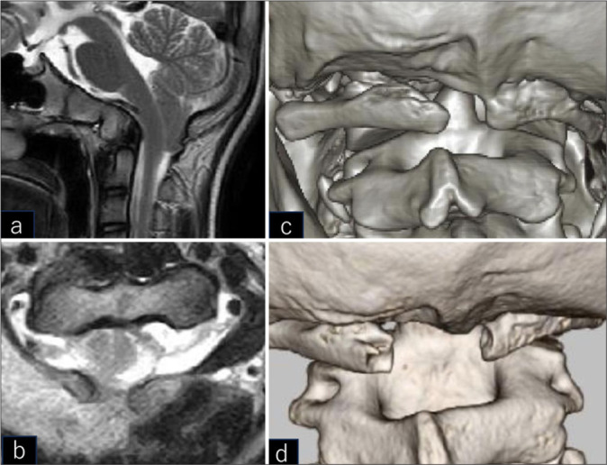 Mini-open exoscopic surgery for C1 restenosis 7 years after decompression of Chiari malformation type 1 with atlas assimilation.