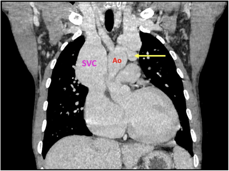 Arteriovenous fistula in the aortic arch: a case report involving 3D models for surgical planning.