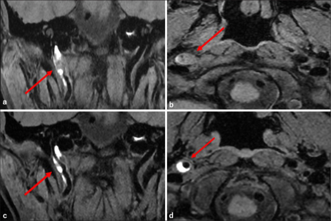 Internal carotid artery dissection presenting with glossopharyngeal nerve dysfunction: A case report.