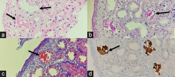 Severe Rhabdomyolysis Due to Presumed Drug Interactions of Dapagliflozin with Rosuvastatin: A Case Report.