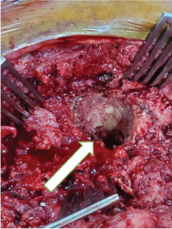 Two-stage Acetabular Impaction Bone Grafting: A Case Report.
