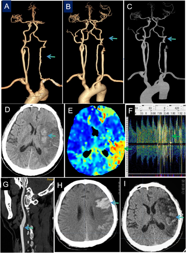 Spontaneous recanalization after acute common carotid artery occlusion: a case report.