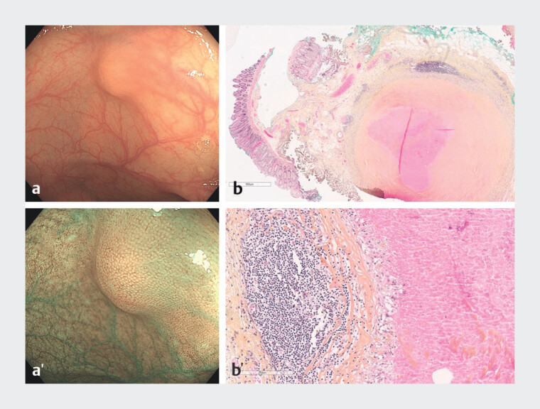 Histology of colonic submucosal lesions reveals a high proportion of benign lesions that do not require R0 en bloc endoscopic resection.