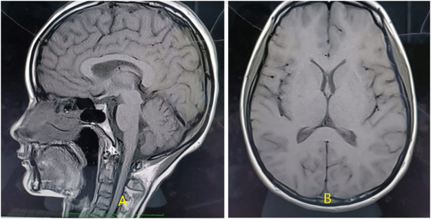 Acquired hemophilia a in a female with minimal change disease and hypothyroidism: a rare case report.