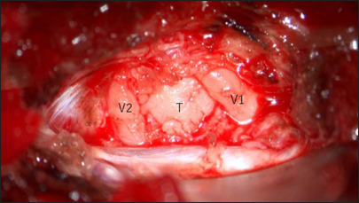 Symptomatic pseudotumor in Meckel cave mimics trigeminal schwannoma.
