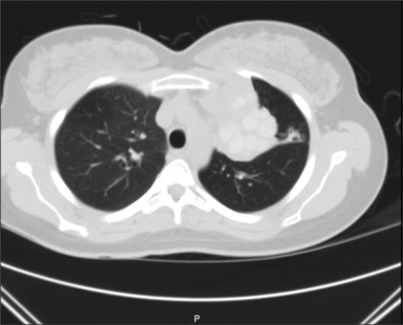 Allergic Bronchopulmonary Aspergillosis Misdiagnosed as Non-resolving Pneumonia: A Case Report.