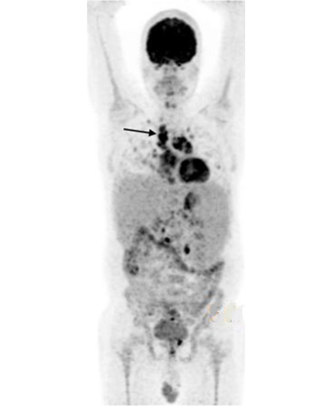 When Less Could be More: Successful Treatment of Granulomatous Lymphocytic Interstitial Lung Disease with Azathioprine.