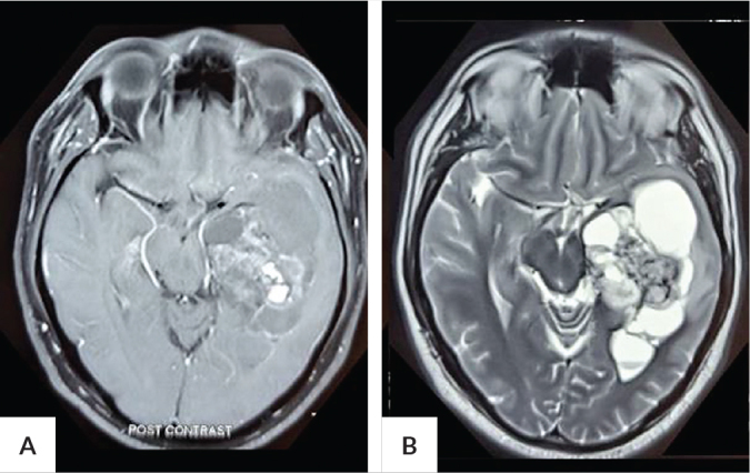 Optical Coherence Tomography of the Macular Ganglion Cell Complex Demonstrating Transsynaptic Retrograde Degeneration from a Temporal Lobe Tumor: A Case Report.