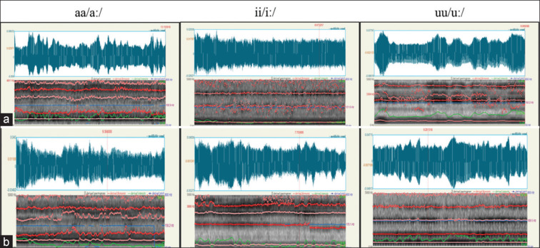 A pilot study comparing conventional and digital impression techniques for speech analysis using Hindi vowels in maxillectomy patients rehabilitated with an obturator.