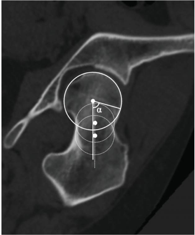 Proximal Femoral Morphology in Development Dysplasia of the Hip Based on Three-Dimensional (3D) Analysis.
