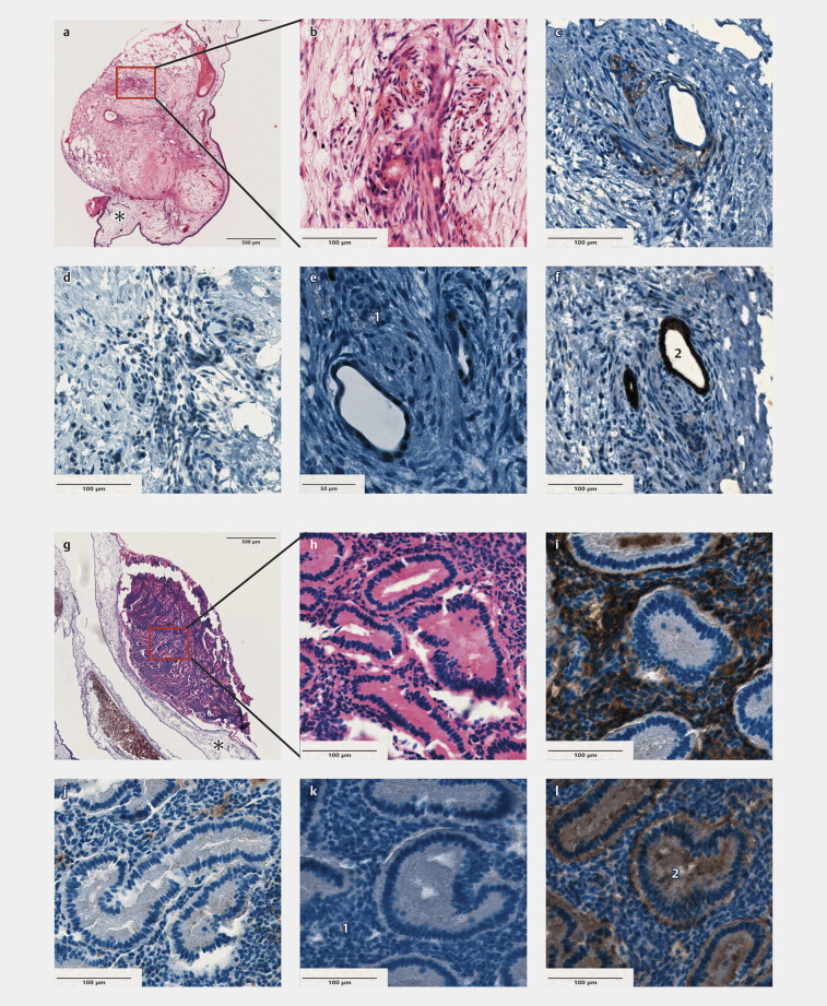 Increase in Angiogenesis and Vascularization in Patient-Derived Endometriosis Tissue: Insights from a 3D In Vivo Model.