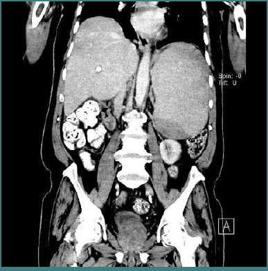 Splenic marginal zone lymphoma associated with chronic inflammatory demyelinating polyradiculoneuropathy: a case report.
