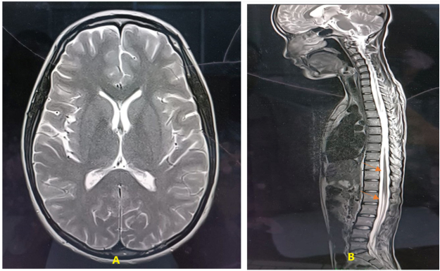 Acquired hemophilia a in a female with minimal change disease and hypothyroidism: a rare case report.