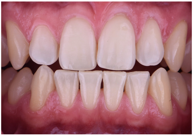 The Use of a Digitally Generated Matrix for Consistent Shade Recording in Tooth Bleaching-A Case Report.