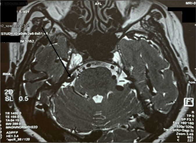 Dandy's vein decompression for trigeminal neuralgia: A rare venous conflict causing intractable facial pain.