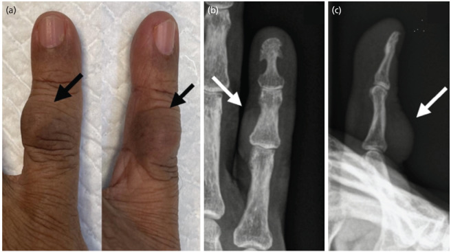 Hamartoma of the Finger: A Case Report.