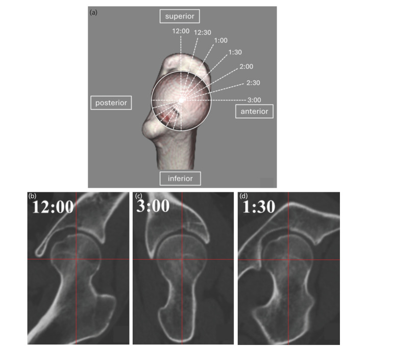 Proximal Femoral Morphology in Development Dysplasia of the Hip Based on Three-Dimensional (3D) Analysis.