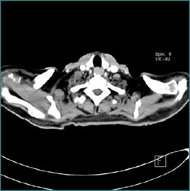 Splenic marginal zone lymphoma associated with chronic inflammatory demyelinating polyradiculoneuropathy: a case report.