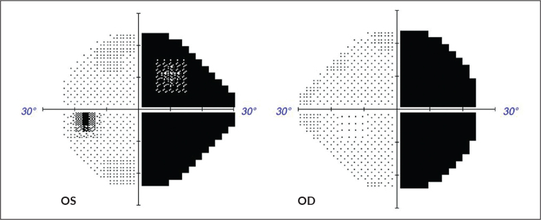 Optical Coherence Tomography of the Macular Ganglion Cell Complex Demonstrating Transsynaptic Retrograde Degeneration from a Temporal Lobe Tumor: A Case Report.
