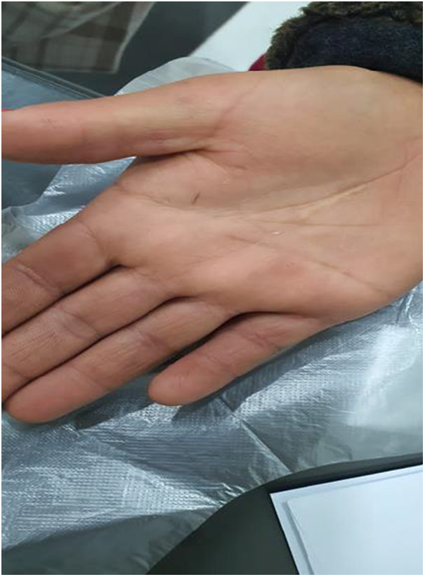 A rare presentation of subcutaneous granuloma annulare: a case report of bilateral palmar and dorsal hand nodules with successful management.