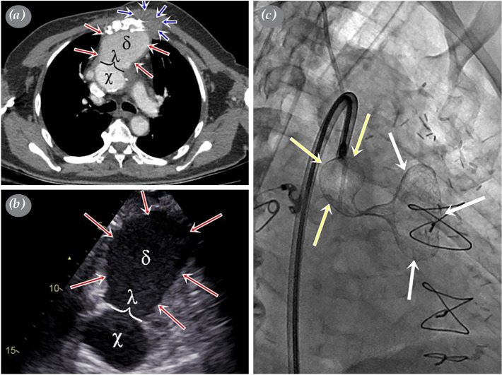 Use of an atrial septal defect occluder for the closure of an ascending aorta pseudoaneurysm after coronary artery bypass grafting.