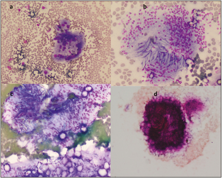 Diagnostic Utility of Fine Needle Aspiration Cytology in a Case of Pulmonary Hydatid Cyst Masquerading as Tuberculosis.