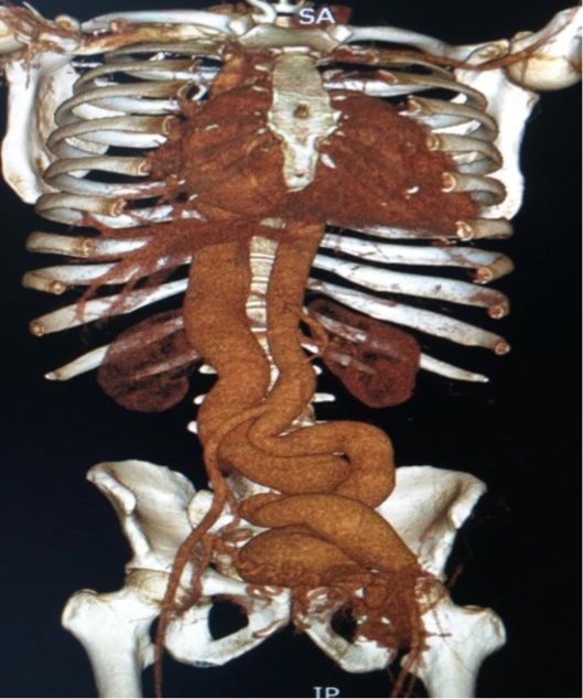 Therapeutic challenge in traumatic arteriovenous fistula of the left lower limb requiring open repair.