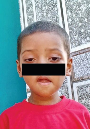 Juvenile Myasthenia Gravis Simulating Bell's Palsy in a 3-year-old Female - A Unique Clinical Presentation.
